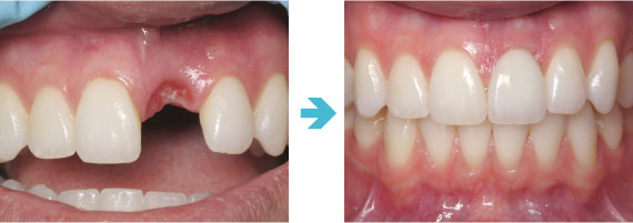 インプラント症例2